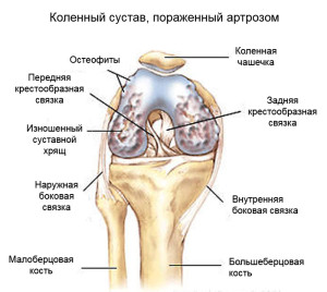 arthritic-knee
